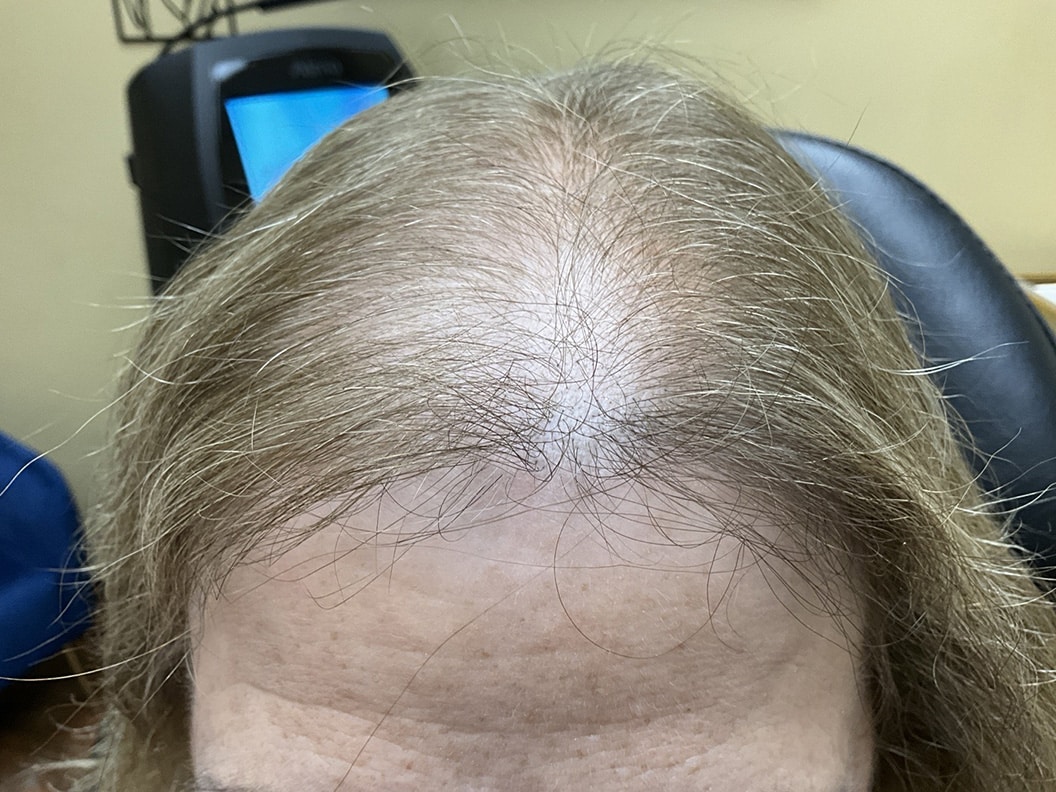 Before Image: TED Hair Restoration Treatments - front