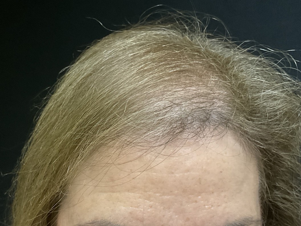 After Image: TED Hair Restoration Treatments - front