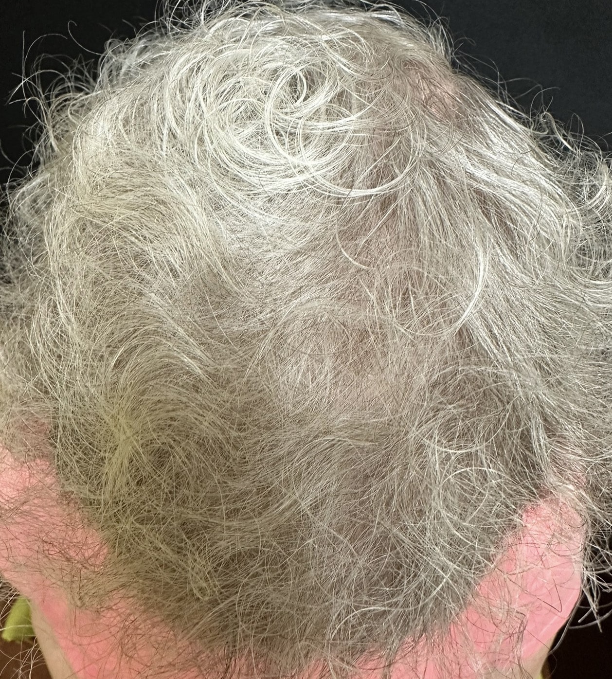 After Image: TED Hair Restoration Procedure - front