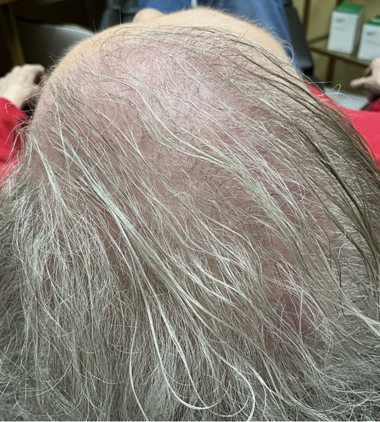 Before Image: TED Hair Restoration Procedure - front
