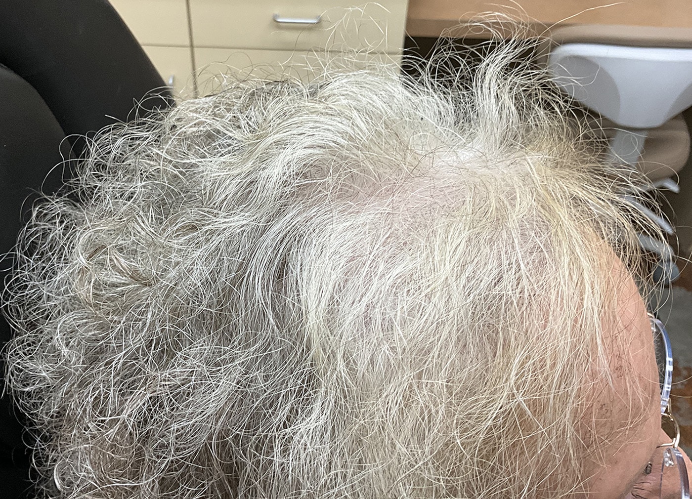 After Image: TED Hair Restoration Procedure - right-side