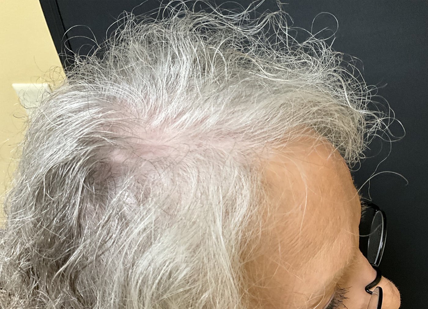 Before Image: TED Hair Restoration Procedure - right-side