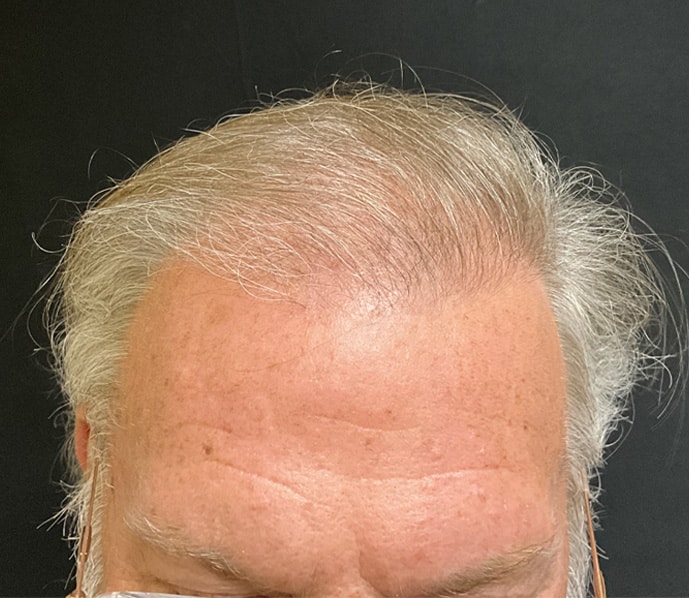 After Image: TED Hair Restoration Procedure - front