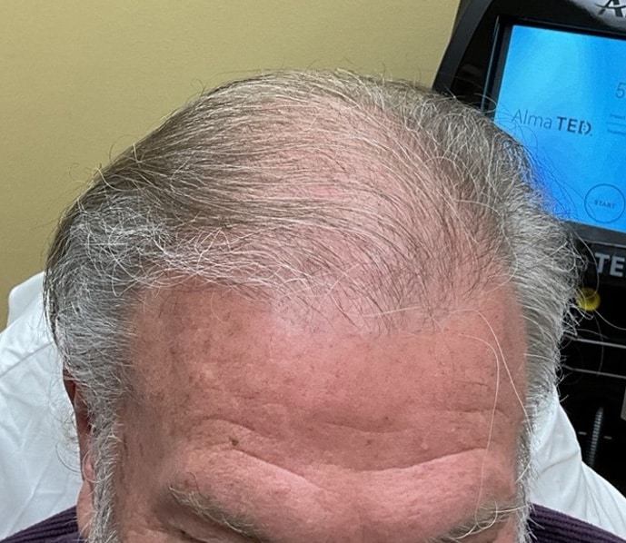 Before Image: TED Hair Restoration Procedure - front