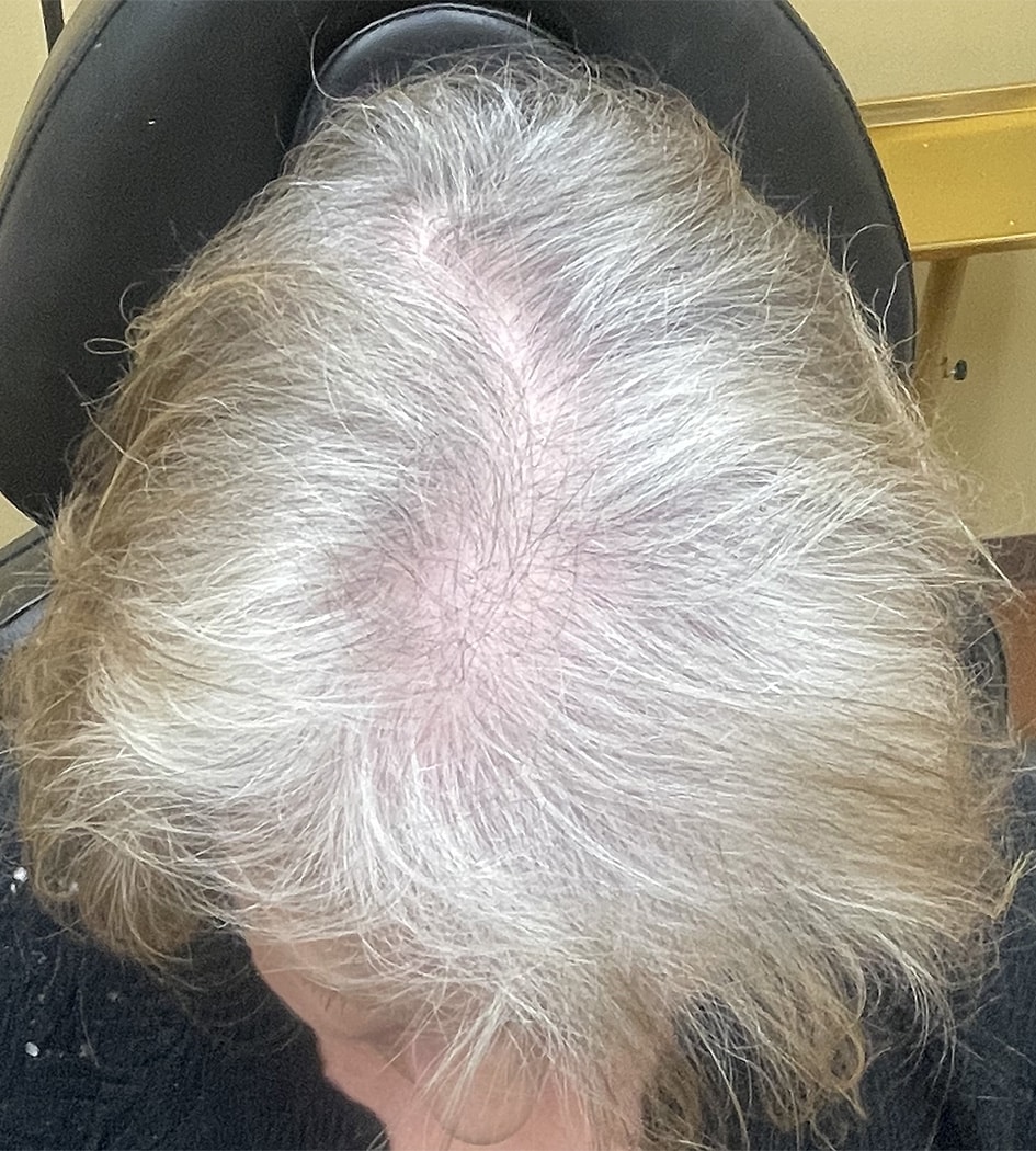 After Image: TED Hair Restoration Procedure - front