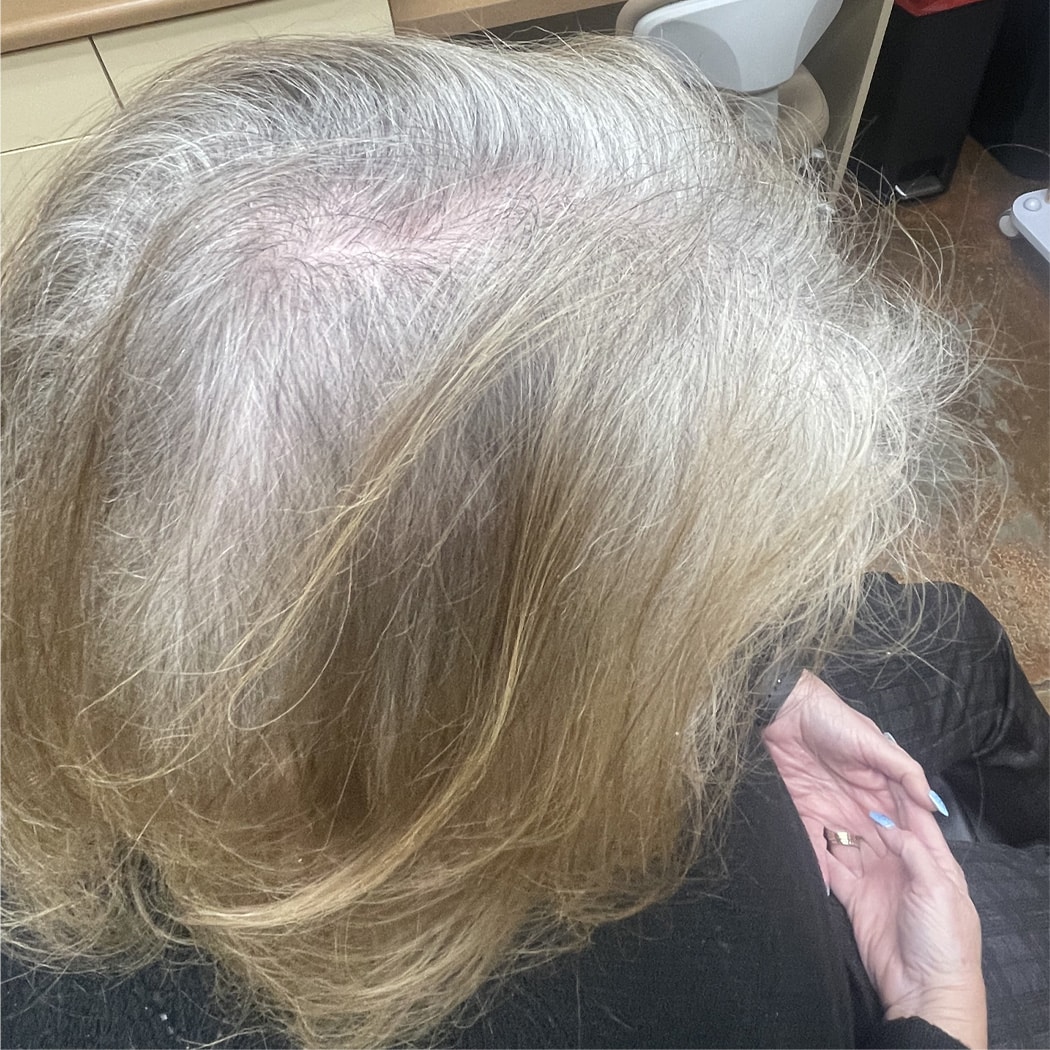 After Image: TED Hair Restoration Procedure - right-side