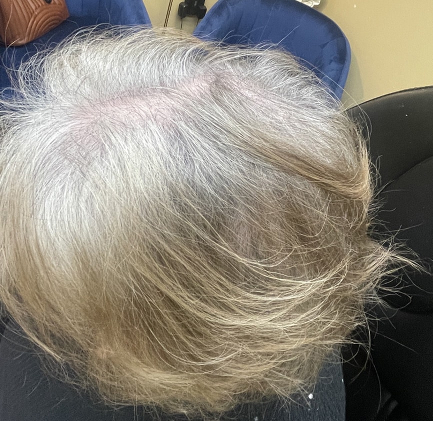 After Image: TED Hair Restoration Procedure - left-side