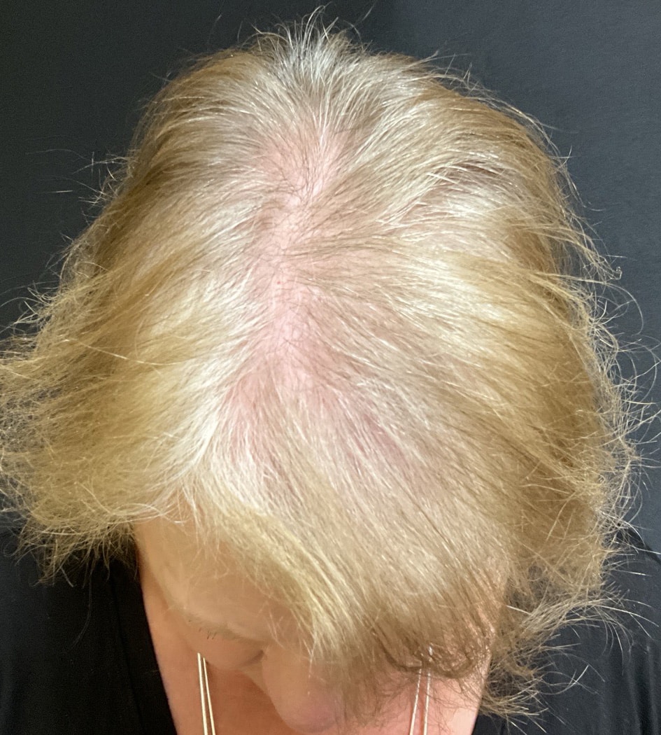 Before Image: TED Hair Restoration Procedure - front