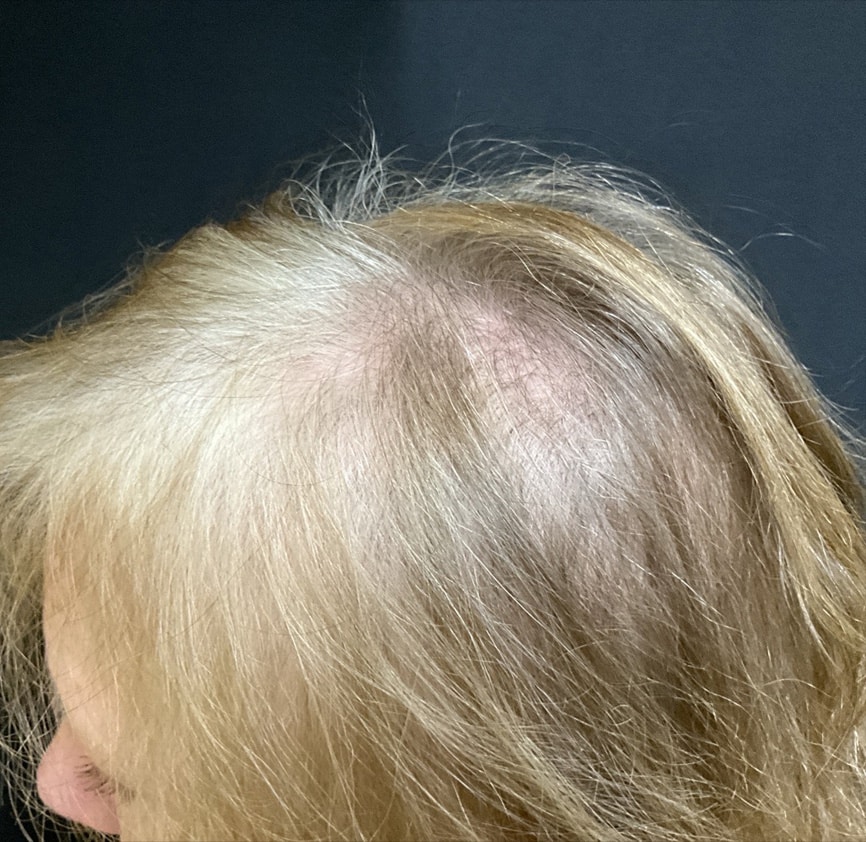 Before Image: TED Hair Restoration Procedure - left-side