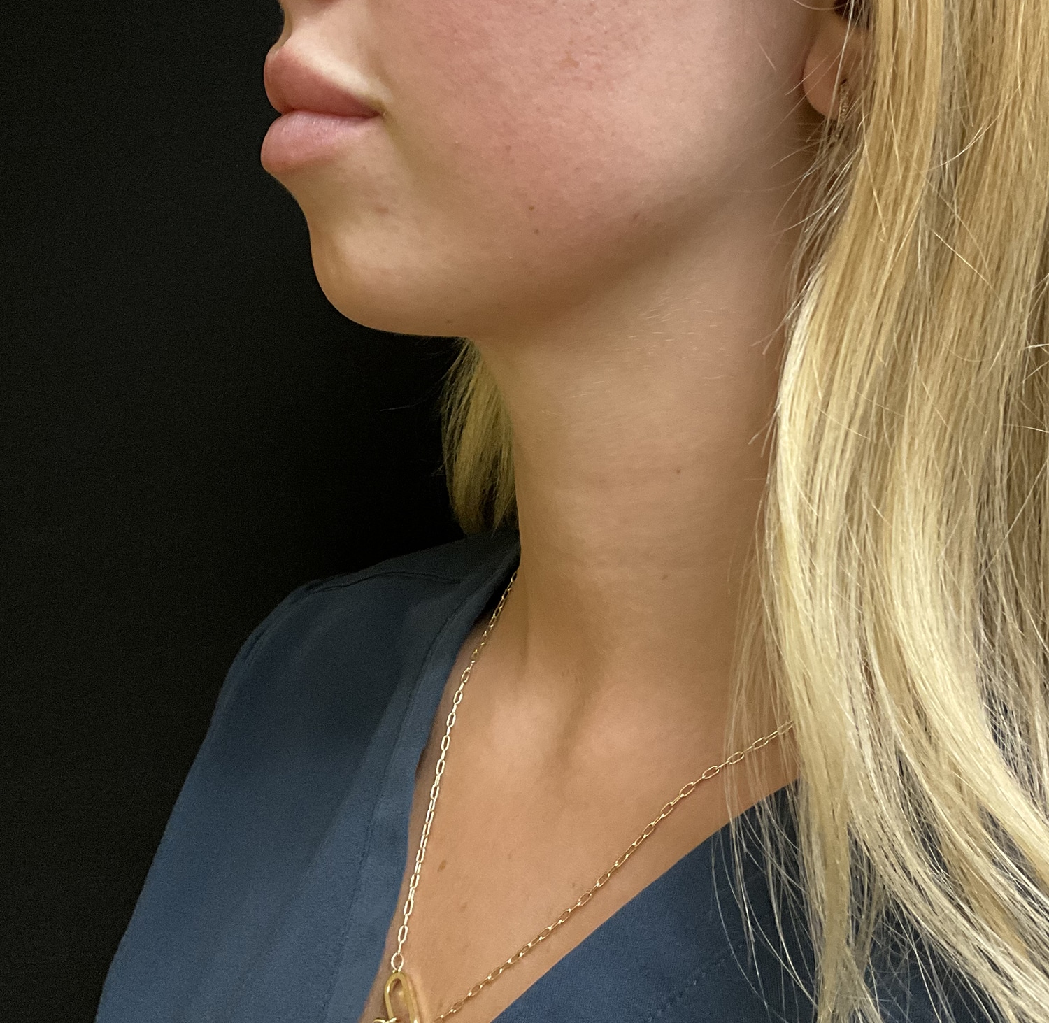 After Image: Before and After Using our Beautifill Laser Liposuction Device on the Chin Area - left-side