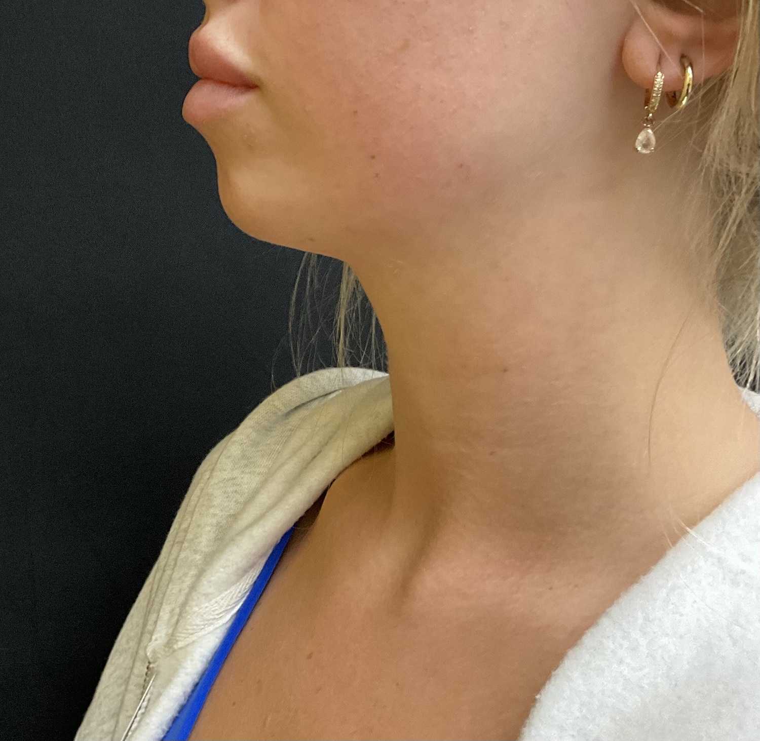 Before Image: Before and After Using our Beautifill Laser Liposuction Device on the Chin Area - left-side