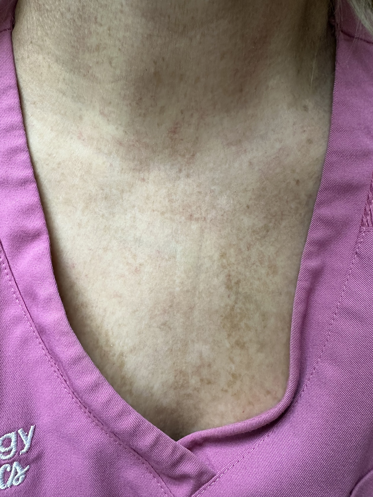 After Image: Alpha Pro removing sunspots - front