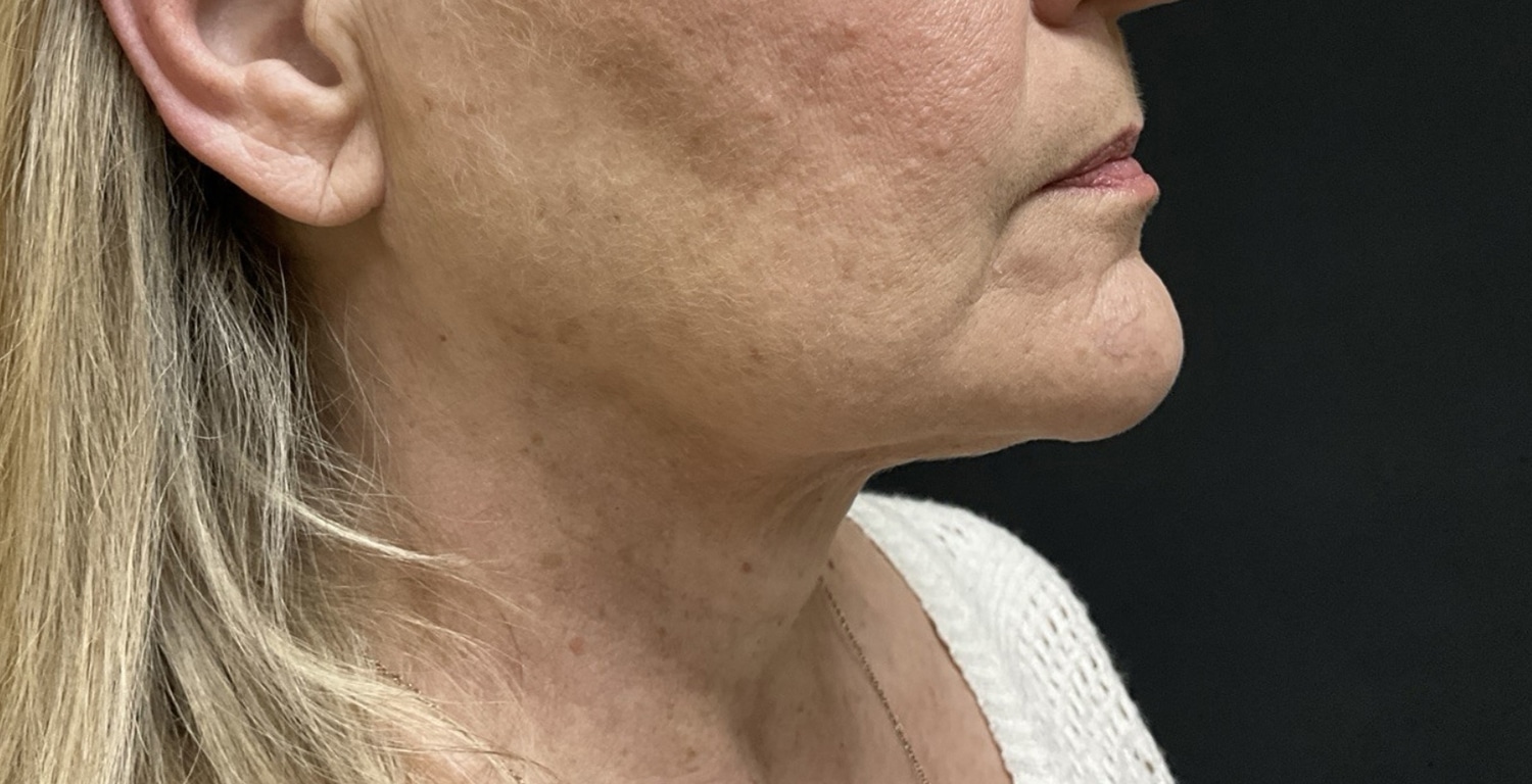 After Image: Before and After Beautifill Laser Liposuction on Chin Area - right-front-oblique