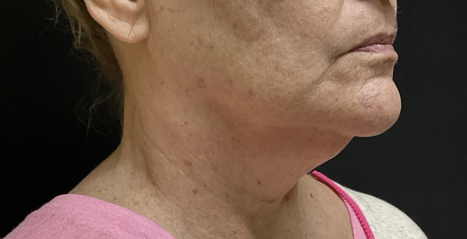 Before Image: Before and After Beautifill Laser Liposuction on Chin Area - right-front-oblique