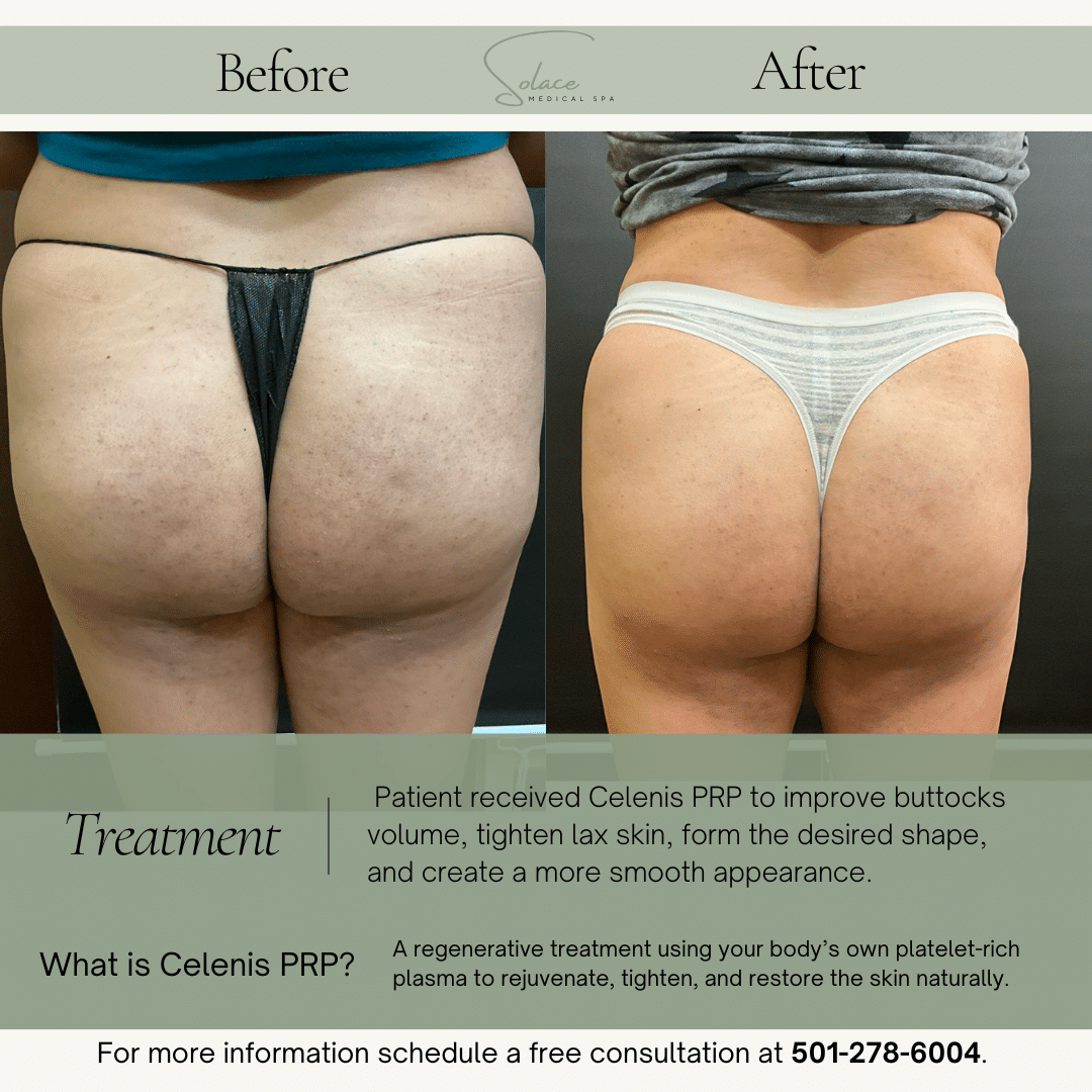 Before and After Image: Cellenis PRP Before and Afters - back
