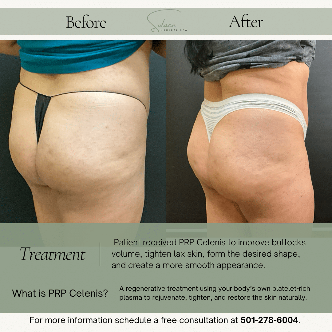 Before and After Image: Cellenis PRP Before and Afters - right-back-oblique