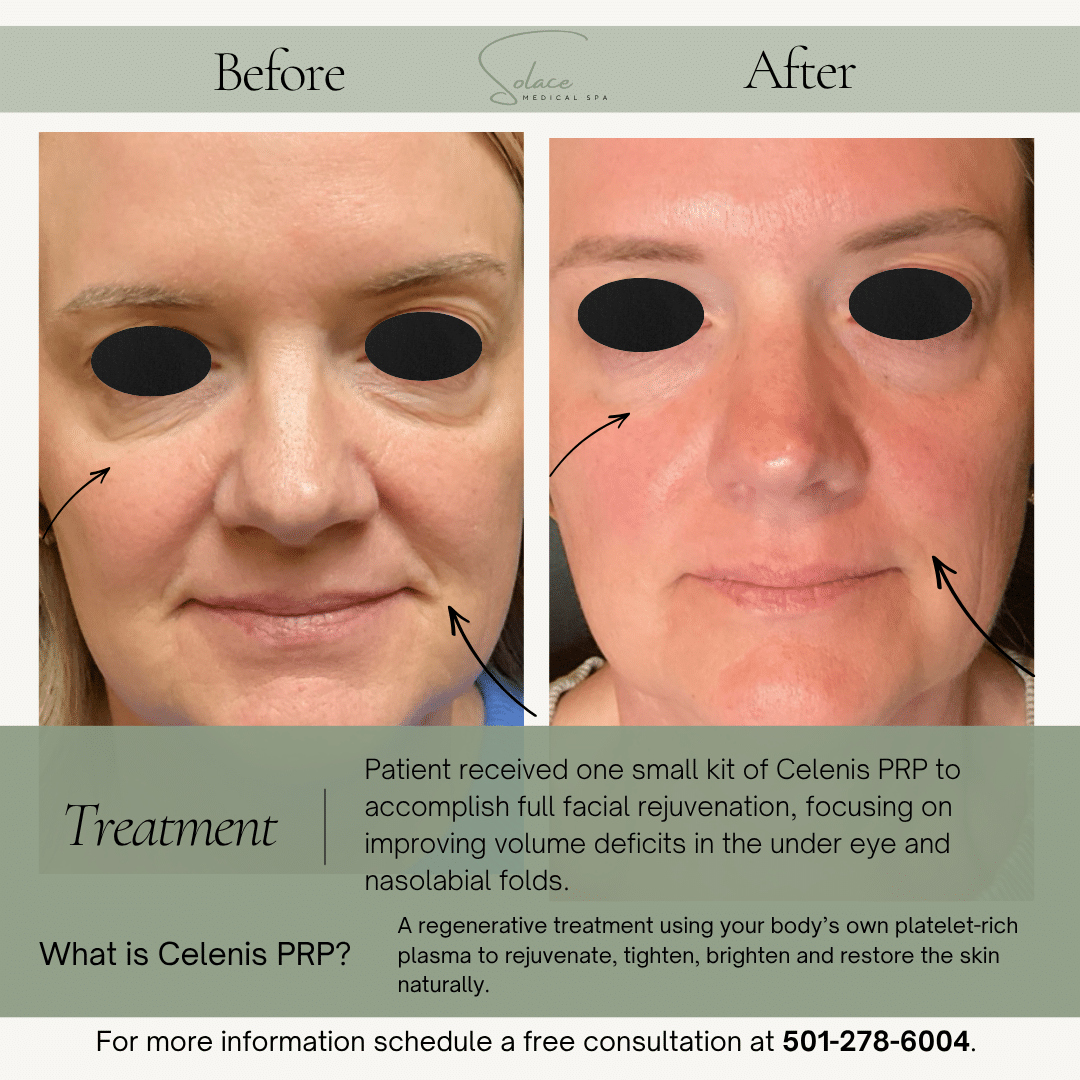 Before and After Image: Cellenis PRP - front