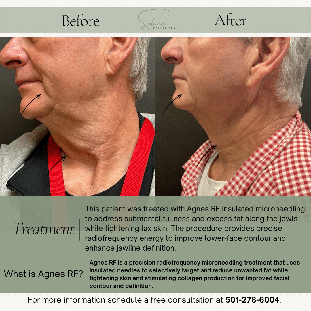 Before and After Image: Agnes RF Jowl Tightening and Lift - left-side