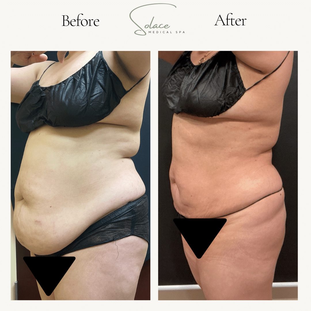 Before and After Image: Before and After Beautifill Laser Liposuction on the abdomen - left-front-oblique