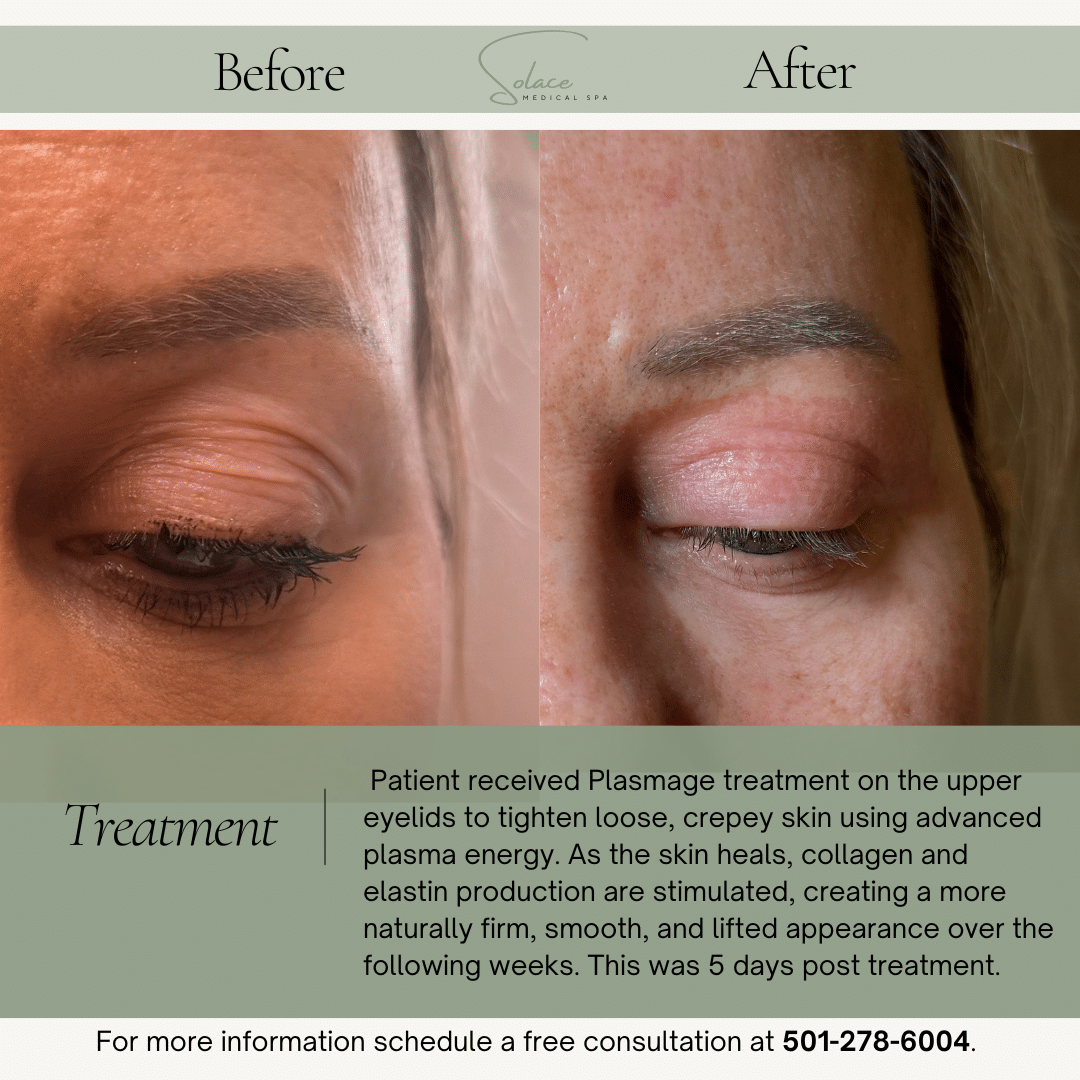 Before and After Image: Plasmage - front