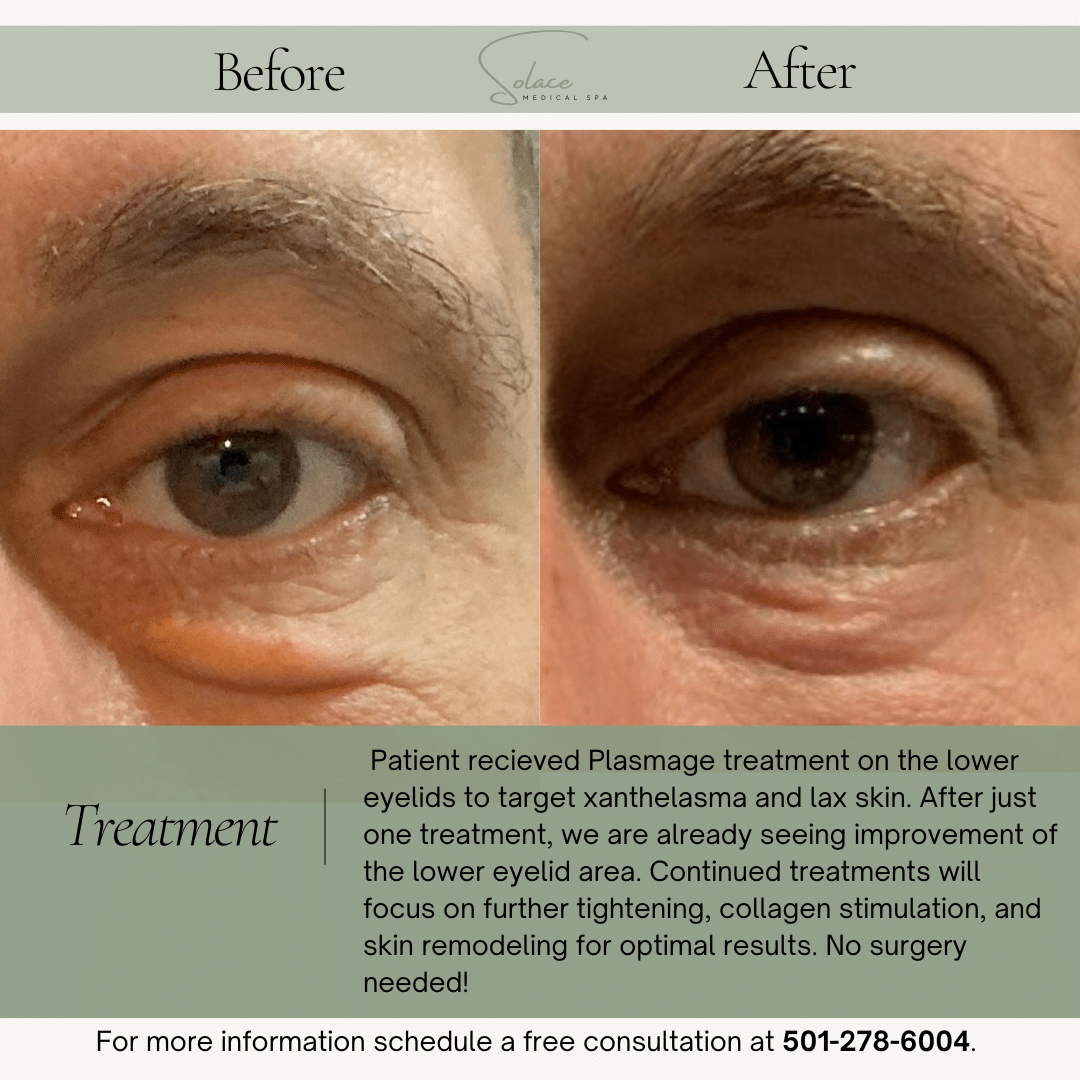 Before and After Image: Plasmage - front