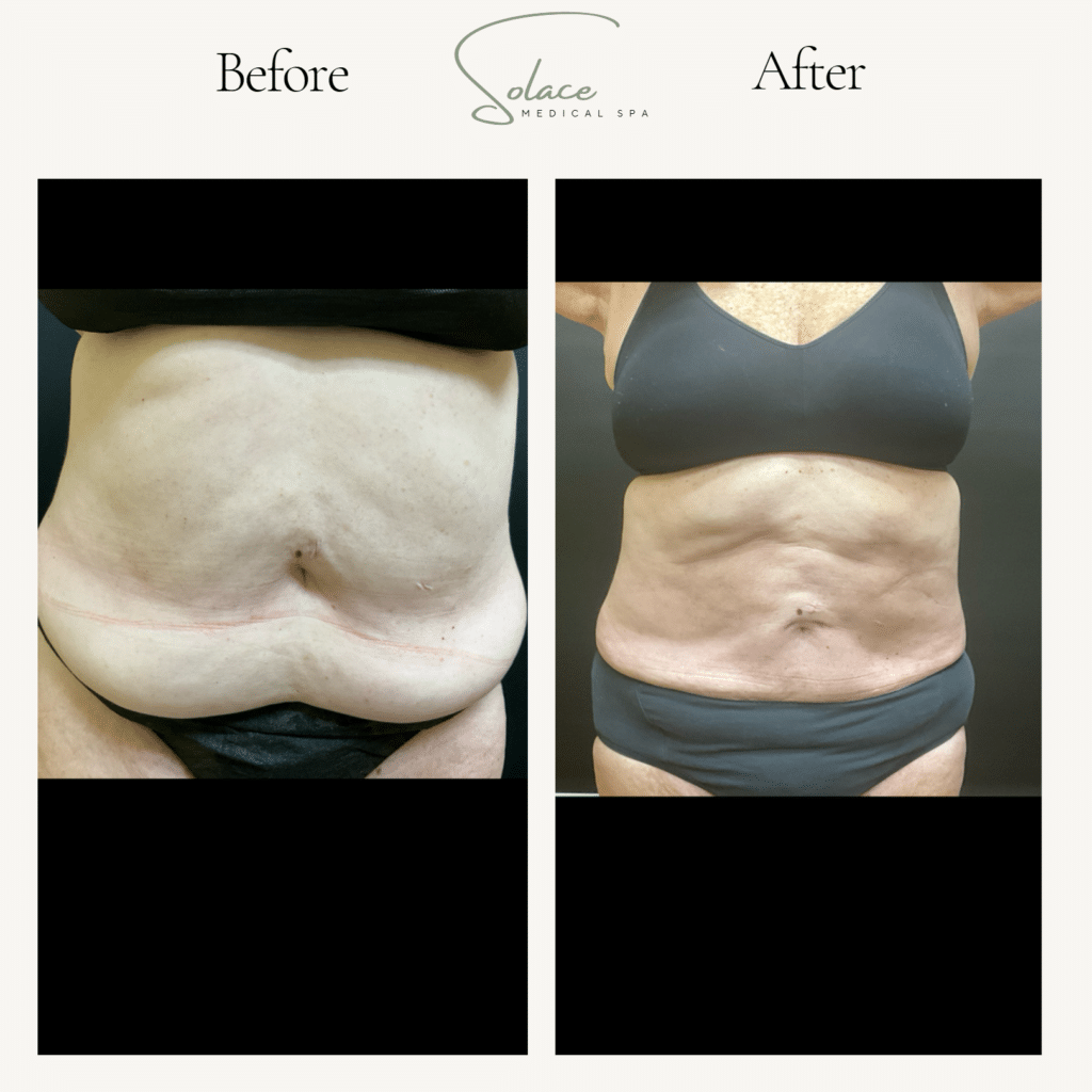 Before and After Image: Beautifill Laser Liposuction Before and Afters - front