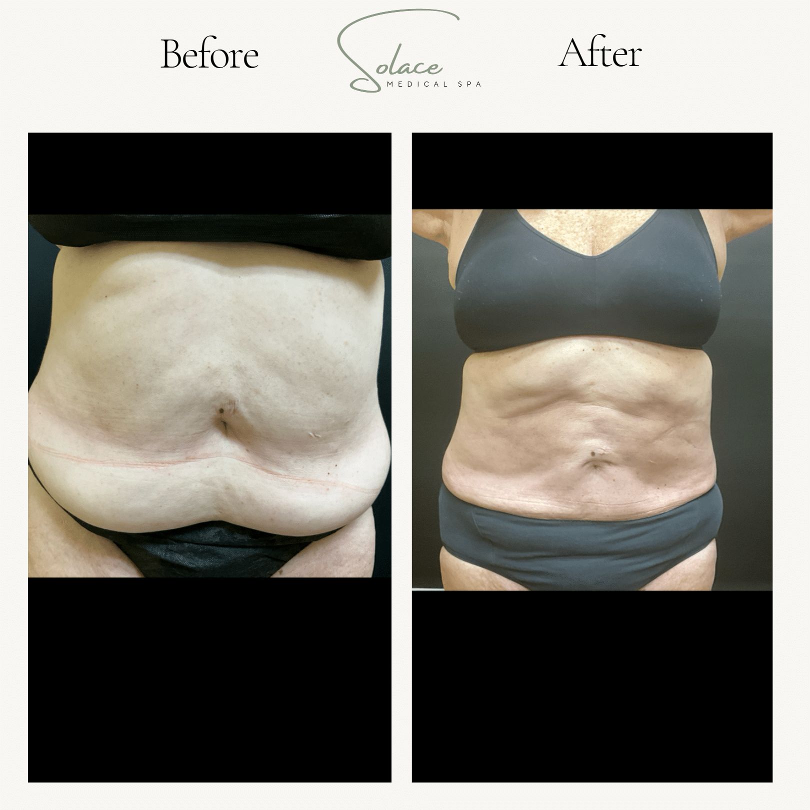 Before and After Image: Beautifill Laser Liposuction Before and Afters - front