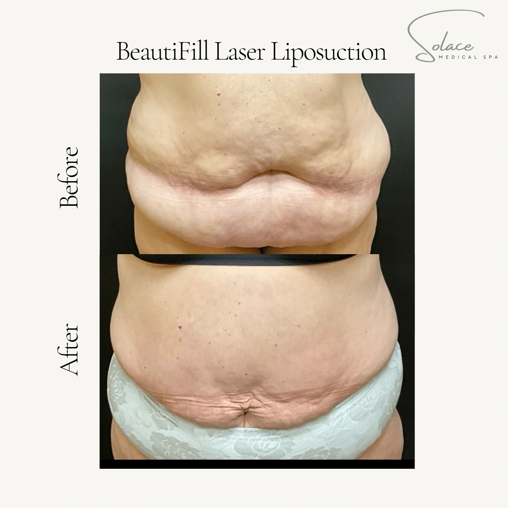 Before and After Image: Beautifill Laser Liposuction Before and Afters - other