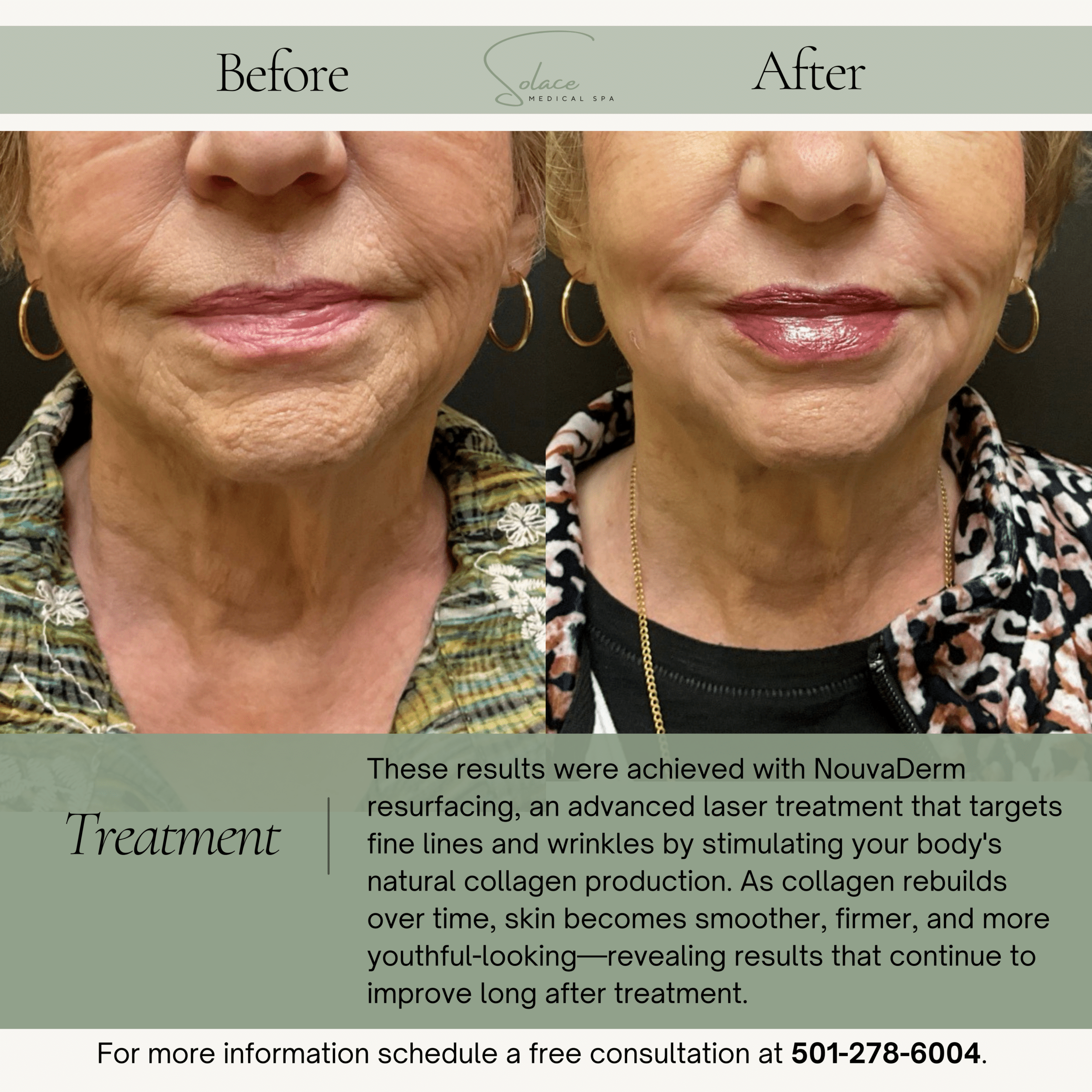 Before and After Image: Nouvaderm Resurfacing Laser - front