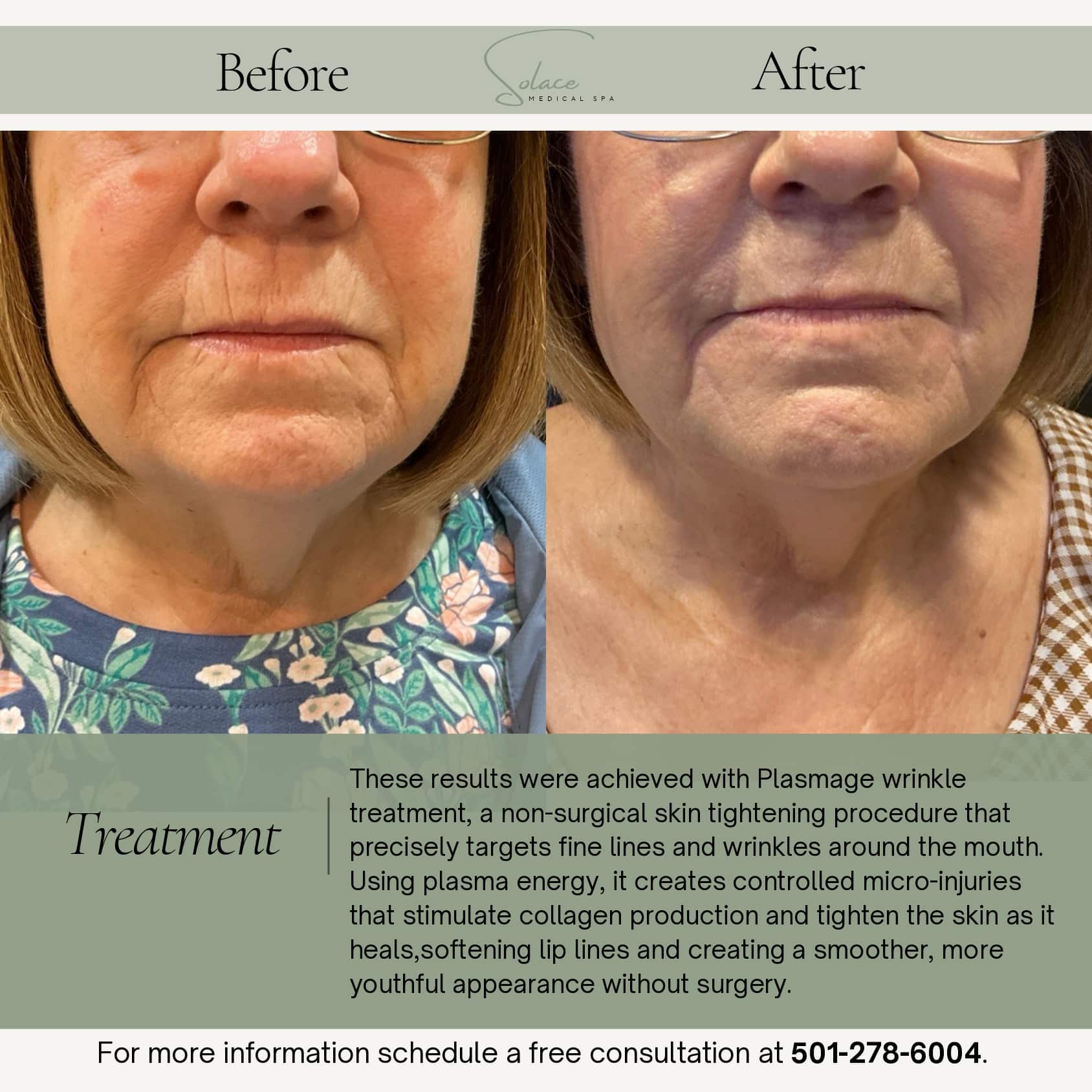 Before and After Image: Plasmage Perioral Wrinkle Treatment - front