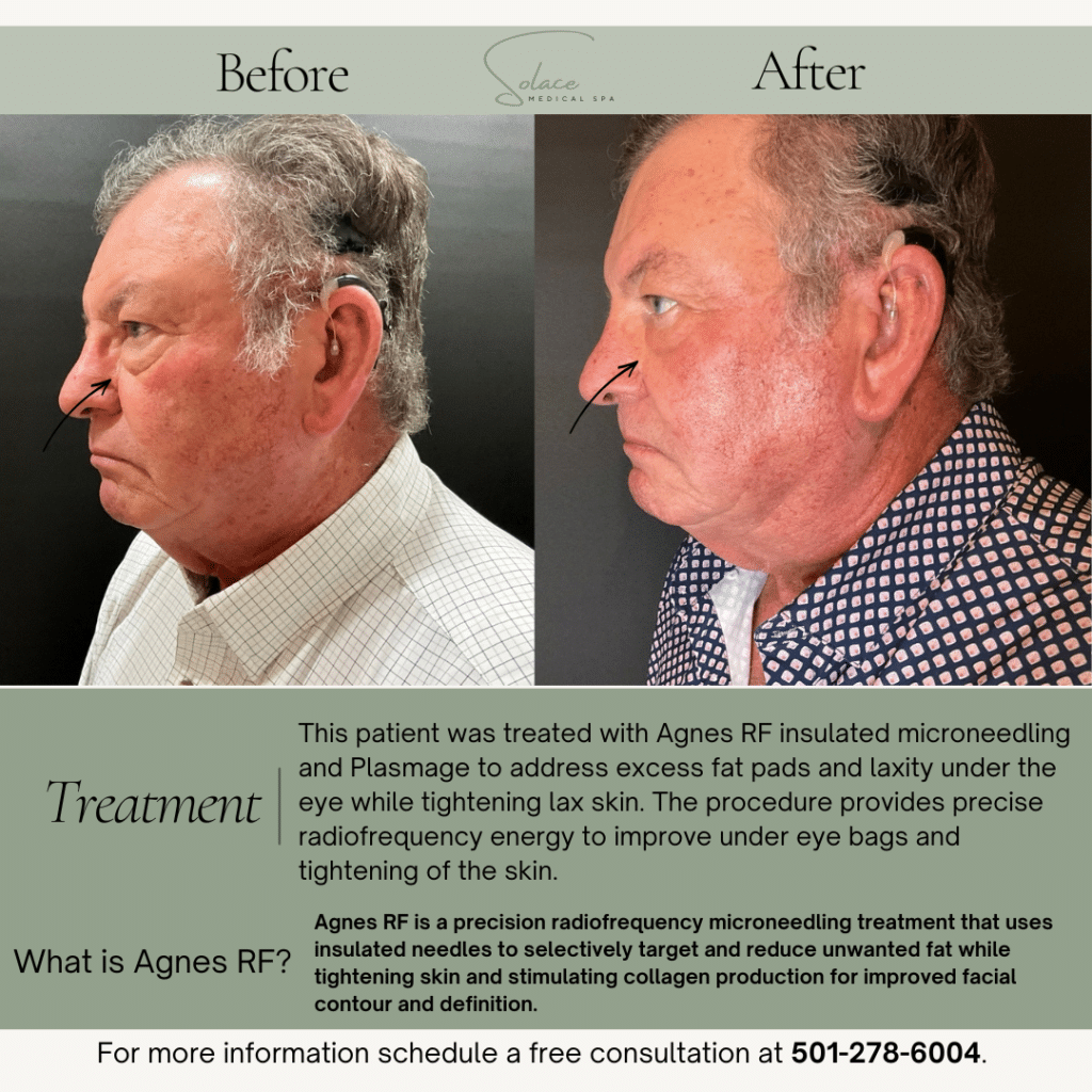 Before and After Image: Agnes before & after - left-side