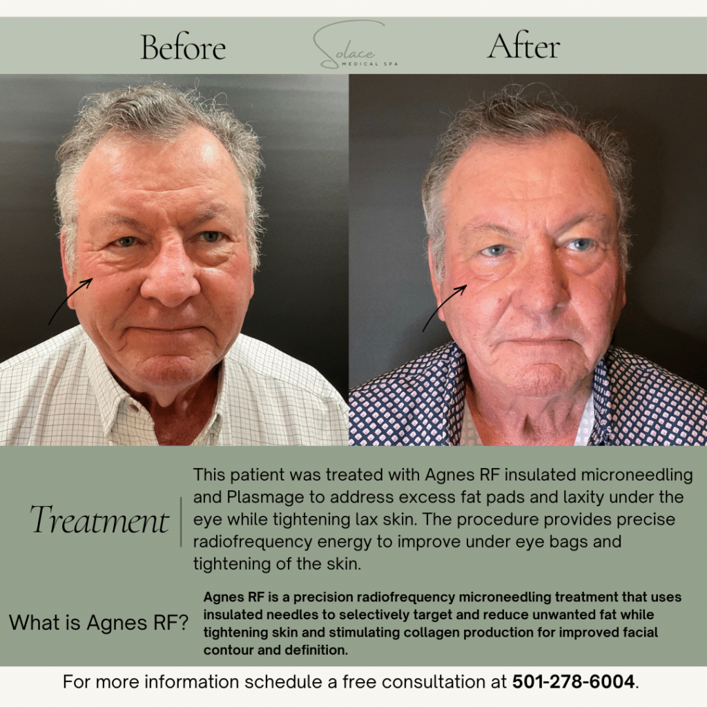 Before and After Image: Agnes before & after - front