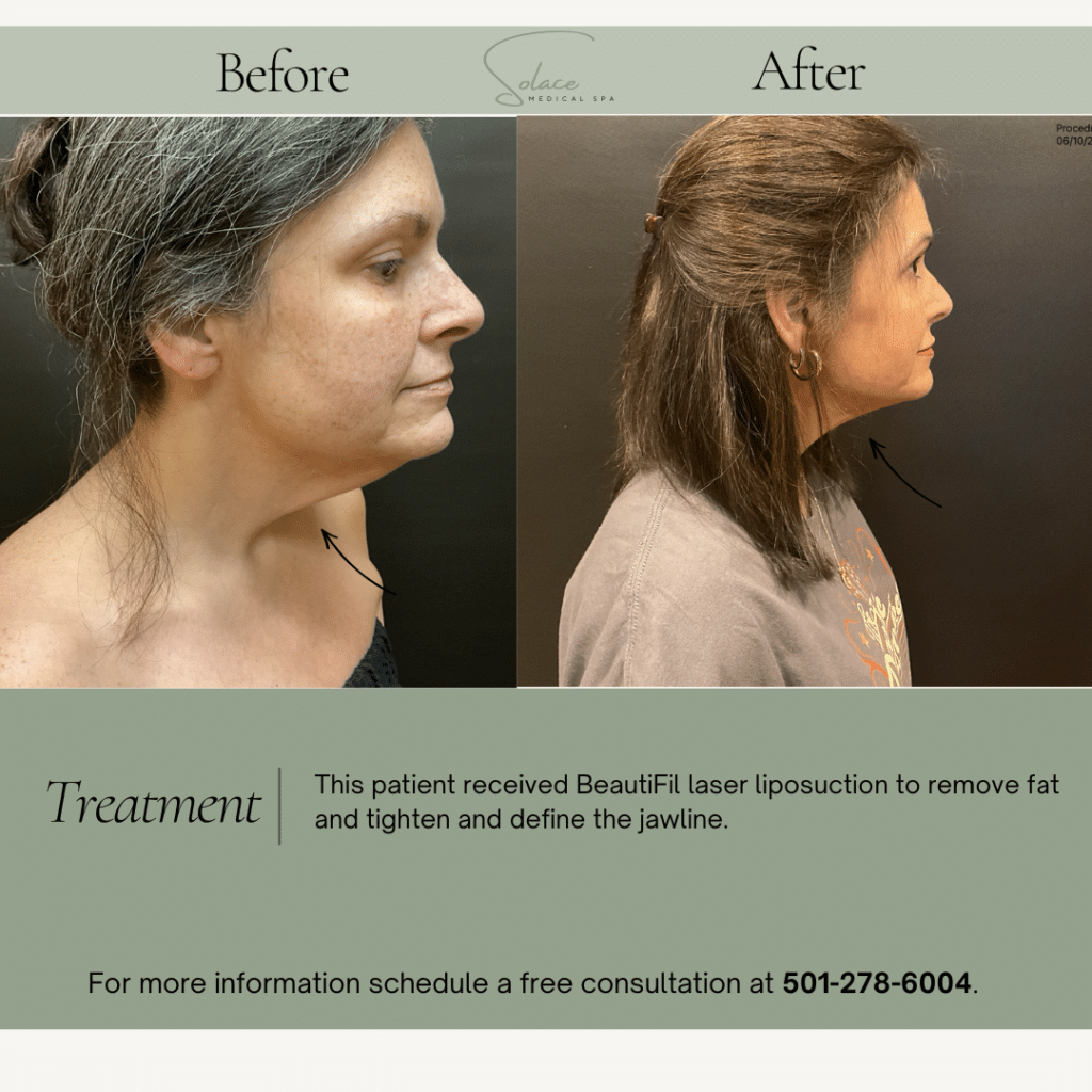 Before and After Image: Beautifill Laser Liposuction Before and Afters - right-side