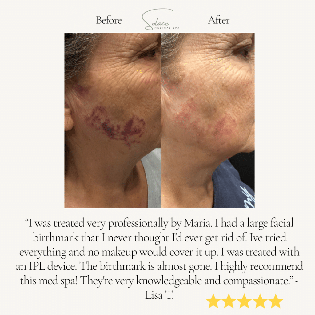 Before and After Image: Alpha Pro IPL - front
