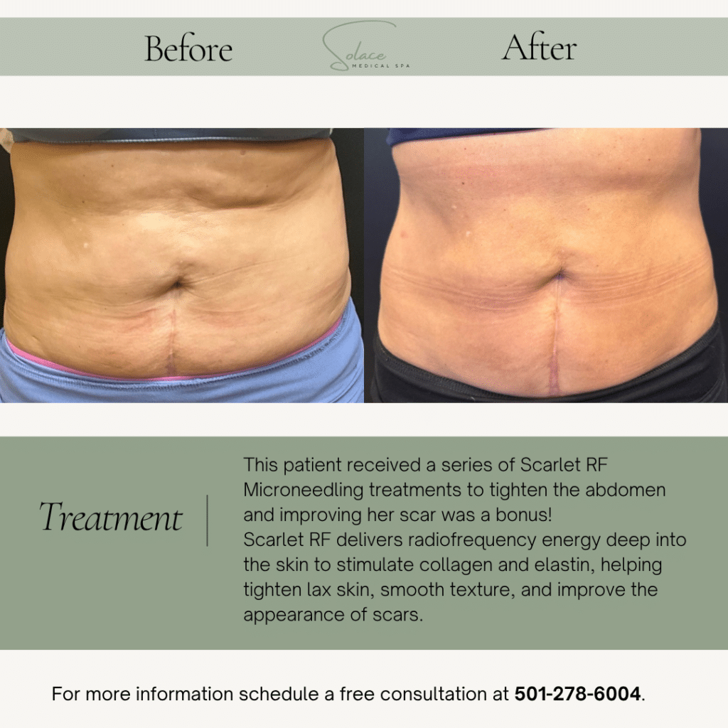 Before and After Image: Scarlet RF Microneedling - front