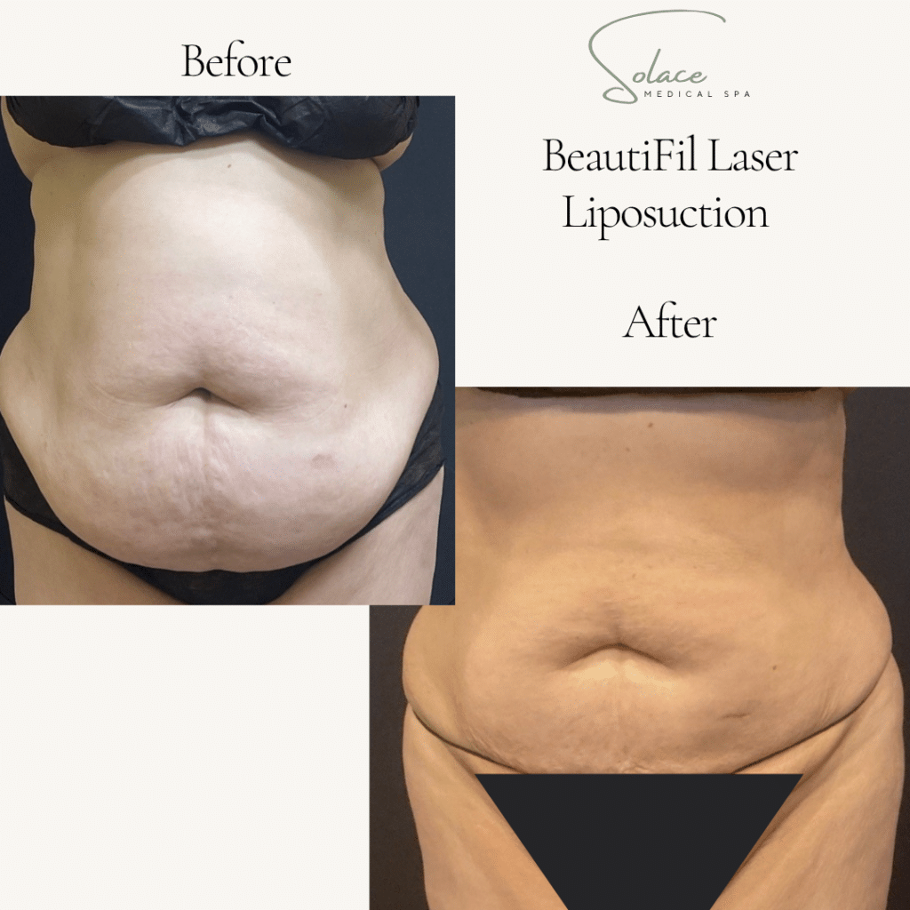 Before and After Image: Beautifill Laser Liposuction Before and Afters - front