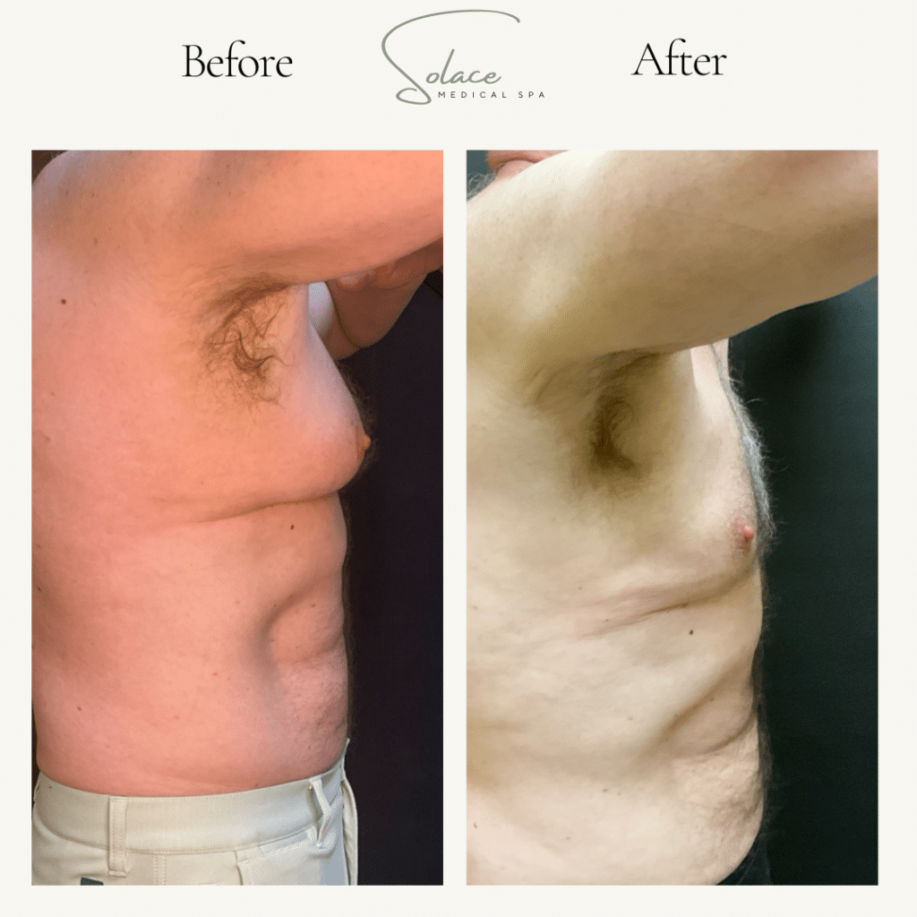 Before and After Image: Beautifill Laser Liposuction Before and Afters - front