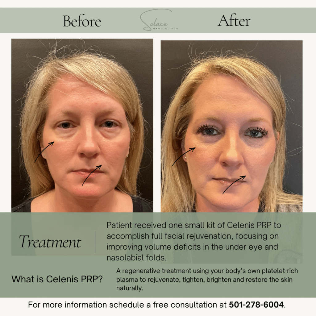 Before and After Image: PRP Before and After - front